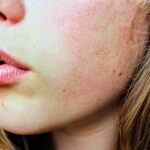 Tipuri de cancer de piele